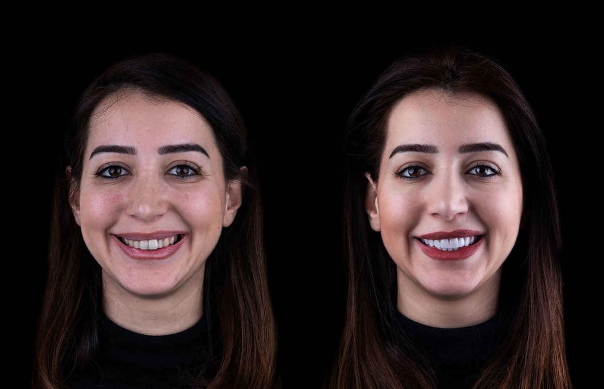 Teeth Whitening, Teeth Whitening Aberdeenshire, Premium Teeth Whitening, Teeth Whitening Huntly